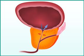 Enlargement of the prostate and compression of the urethra