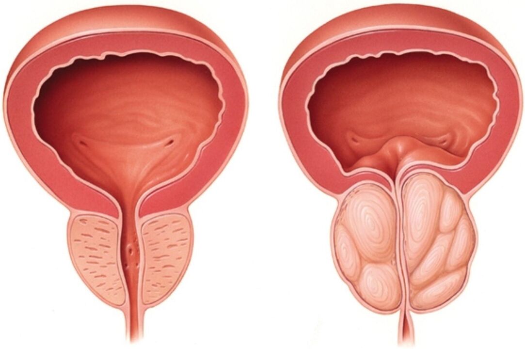 Normal prostate (left) and signs of inflammation in the prostate (right)