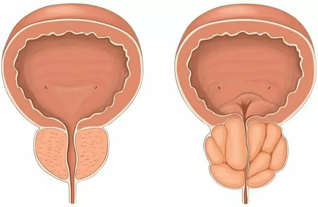 Normal prostate and sore prostate