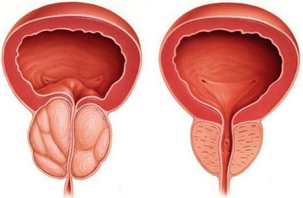 healthy and inflamed prostate with prostatitis